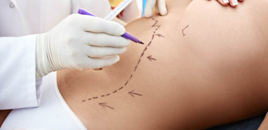 Liposuction - Costa Rica